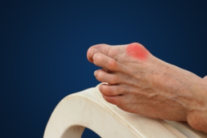 Bunion Treatment