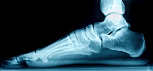 Recognizing the Symptoms of Flat Feet