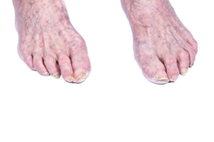 What Is Onychogryphosis?