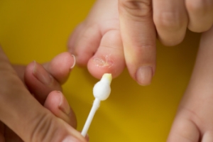 Preventing Ingrown Toenails in Children