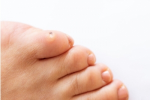 Professional Removal of Corns