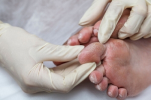 Managing Pain of Diabetic Foot Problems