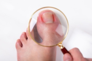 Treatment for Infected Ingrown Toenails