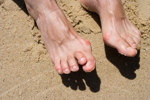 Hammertoe Facts