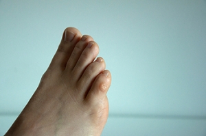 Three Types of Corns on the Feet